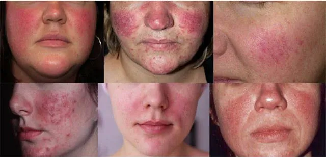 TRỨNG CÁ ĐỎ (CHỨNG ĐỎ DA) (Rosacea, Red Skin Rash)