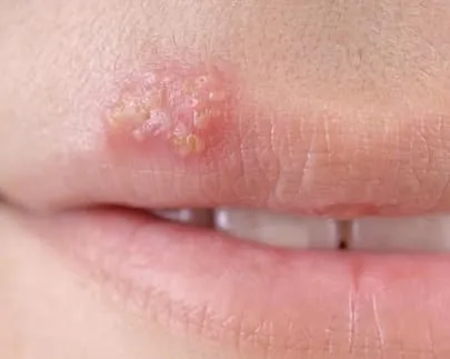 BỆNH MỤN RỘP (HERPES)