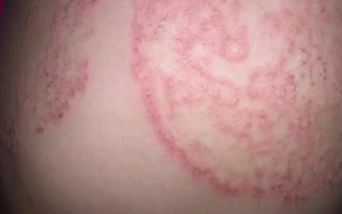 BỆNH NẤM NỐNG Ở DA (Superficial fungal skin infections)
