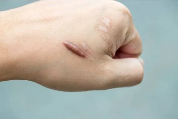 SẸO LỒI (Keloidal Scar - Keloids)