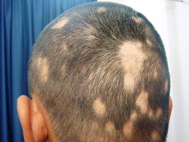 RỤNG TÓC VÙNG (Alopecia Areata)