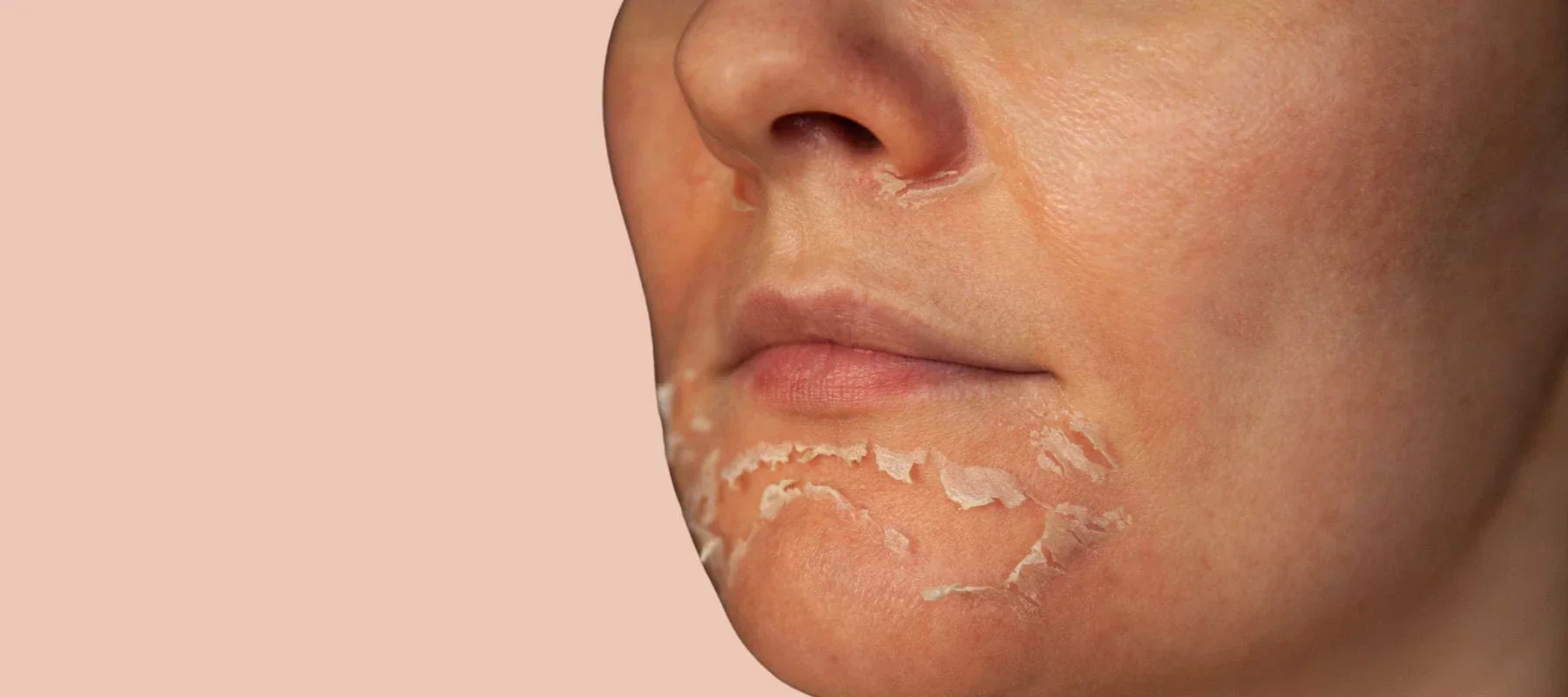 Chăm sóc da tại nhà sau peel, laser